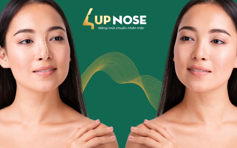 nâng mũi cấu trúc